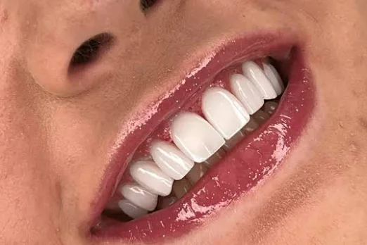 اصلاح طرح لبخند در ظفر